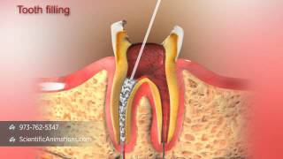 Root Canal Treatment [upl. by Harelda583]