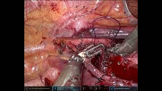 MId tracheal resection at innominate artery robotically on VV ECMO [upl. by Damek129]