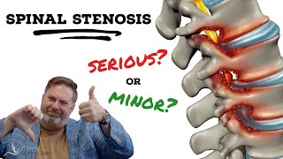 Is Spinal Stenosis serious  The Clinic Episode 1 [upl. by Crandall996]