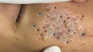 Blackheads amp Whiteheads Satisfying Removal 0284 [upl. by Ravid50]