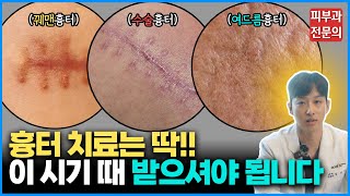 여드름 흉터 켈로이드 흉터 각종 흉터의 골든타임과 치료시기 알려드립니다 [upl. by Annavoig]