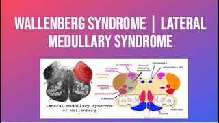 Wallenberg Syndrome  Lateral Medullary Syndrome  PhysiotherapyKnowledge [upl. by Neroc177]