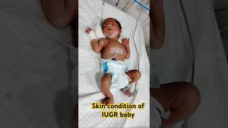 Skin condition of IUGR baby ytshorts shorts trending viralvideo shortsviral new skincare [upl. by Einahteb]