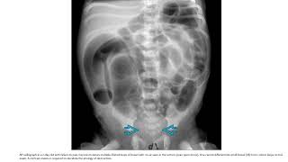 Hirschsprung Disease Imaging [upl. by Eitsim]