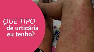 Que tipo de urticária eu tenho [upl. by Atronna]