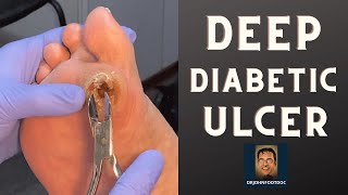 DEEP Diabetic Foot Ulcer podiatristfoot and ankle specialist treats a foot ulcer [upl. by Gillead]