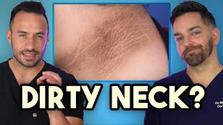 Dark Neck Armpits Groin How to Treat and Prevent Acanthosis Nigricans [upl. by Marji884]