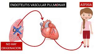 24052020 ENDOTELITIS TROMBOSIS Y ANGIOGENESIS EN COVID 19 ANALISIS DE ARTICULO  NEJM [upl. by Hsaniva673]