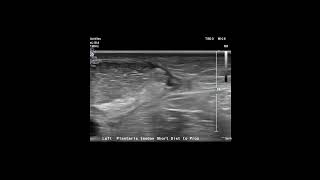 How to locate the plantaris tendon of the calf on your MSK Ultrasound exam [upl. by Uriisa]