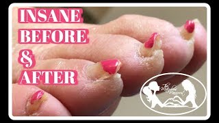 Pedicure Tutorial Elderly Thick Toenails Growing Up Transformation [upl. by Pace]