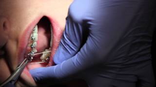 Curtis Braces  Finishing Rubber Band Tutorial [upl. by Maltzman]