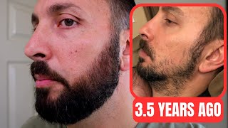 Minoxidil Beard Journey 35 Years Later  How To Grow A Real Beard [upl. by Aeriell]