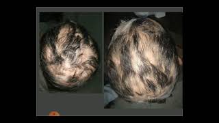 Dermoscopy of cicatricial alopecia 1 Dr Rania Al Akad Discoid Lupus of the scalp [upl. by Ramhaj]