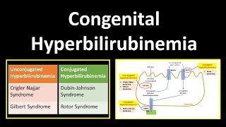 Congenital Hyperbilirubinemia  Crigler Najjar SyndromeGilbert SyndromeDubinJohnson Syndrome [upl. by Lynn]