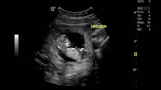 11 semanas de embarazo Ultrasonido feliz  Happy ultrasound 11 weeks of pregnancy [upl. by Beaulieu]