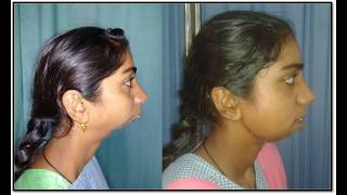 Everything you need to know about facialJawdeformity amp how it is treated by Orthognathic surgery [upl. by Nede]