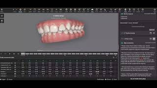 Carriere Motion Appliance  Invisalign [upl. by Sugihara]