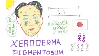 Xeroderma Pigmentosum [upl. by Inglis977]