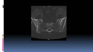 126 Sacroiliac Joint Dysfunction SIJ Fusion [upl. by Akenal]