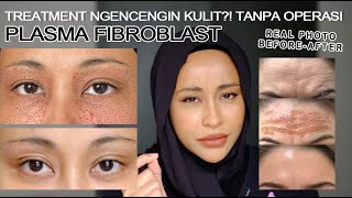 PLASMA FIBROBLAST NGENCENGIN KULIT WAJAH ALTERNATIF OPERASI [upl. by Anelej]