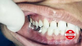 Cementation of Bridge 454647 painless dentist [upl. by Tamberg]