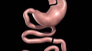 Roux en Y Gastric ByPass  Metabolic Bariatric Surgery animation [upl. by Teressa]