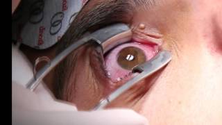 Corneal Iontophoresis Procedure [upl. by Adnahs]