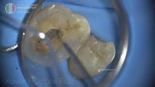 Endodontic diagnostic MB2 canal detection with Explora amp Mirror [upl. by Swayder768]