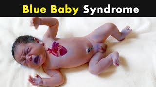 Cyanosis  Blue Skin Color in babies  Symptoms Causes and Treatment UrduHindi [upl. by Heurlin]