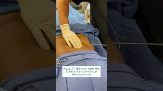 SmartLipo Procedure on Patients Abdomen [upl. by Stovall]