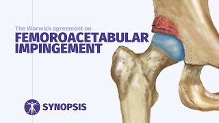 Femoroacetabular Impingement FAI Syndrome  SYNOPSIS [upl. by Omora]