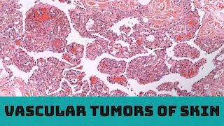 Vascular Tumors of Skin 31 cases in 3 hours Board Review for Pathology Dermatology Dermpath [upl. by Osnofledi]