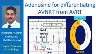 Adenosine for differentiating AVNRT from AVRT [upl. by Temp]