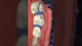 ¡🔥Instalación de separadores dentales en dientes de leche 🦷🔥 [upl. by Staal]