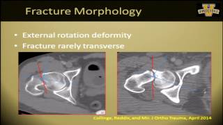 Femoral neck fractures in the young adult what makes sense [upl. by Kizzie787]