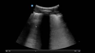 POCUS  COVID Lung Ultrasound [upl. by Mills446]