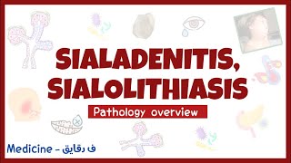 Sialadenitis amp Sialolithiasis  salivary gland diseases pathology overview head amp neck surgery شرح [upl. by Eicul349]