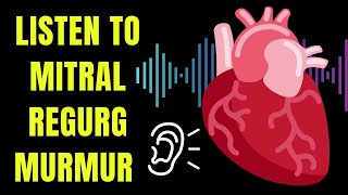 Listen to a Mitral Regurgitation heart murmur  and learn about causes symptoms and treatment [upl. by Ydnem314]