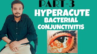 HYPERACUTE BACTERIAL CONJUCTIVITIS PART3 [upl. by Hamrnand315]