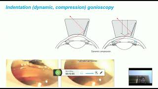 Direct and indirect gonioscopy grading systems ie shaffer scheie and spaeth [upl. by Drahsir]