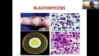 Systemic mycosis [upl. by Aivon]