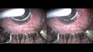 Angle recession glaucoma a new way of doing Microtrack filtration [upl. by Hsot]