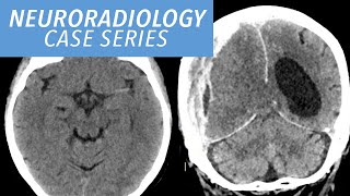 HighYield Neuroradiology Case Review MustKnow Diagnoses Explained [upl. by Ayahc]