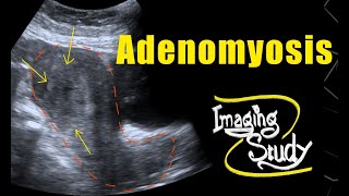 Adenomyosis  Ultrasound  Case 69 [upl. by Belva]