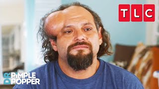 This Man Feels Like a Monster  Dr Pimple Popper  TLC [upl. by Gypsy580]