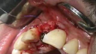 3i Implant placement in the aesthetic zoneafter EASY GRAFT socket preservation [upl. by Rodriguez]