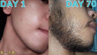 Minoxidil Beard Journey 10 WEEK TRANSFORMATION [upl. by Chara]