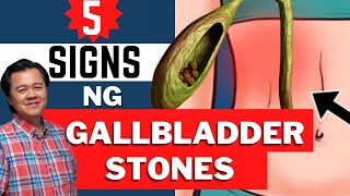 5 Warning Signs ng Gallbladder Stones na Hindi Mo Alam  Payo ni Doc Willie Ong [upl. by Bosson]