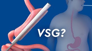 Vertical Sleeve Gastrectomy [upl. by Akers]