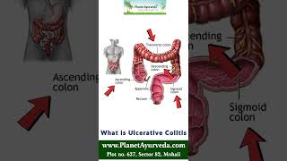 What is Ulcerative Colitis and What Difference is between Colitis and Ulcerative Colitis [upl. by Nies]